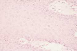 Fig. 3 y 4 Imágenes histopatológicas donde se evidencia la hiperplasia epitelial,
alargamiento de los mamelones epiteliales y las figuras mitosoides