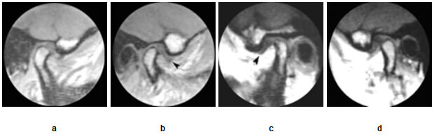 Figura 2 Imágenes en boca abierta, lado derecho (a,b), mostrando translación normal del cóndilo; y lado izquierdo (c,d), configurando inmovilidad del disco (adherido al componente temporal) y severa restricción del movimiento de translación del cóndilo.