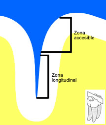 Figura 7. Partes de una fisura.