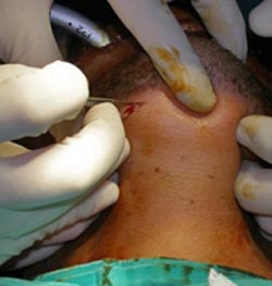 Figura 4 A: Incisión de 2,0 cm en la piel de la región submentoniana paramediana derecha paralela y adyacente al borde inferior de la mandíbula.