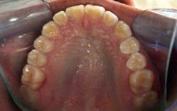 FIGURA 19 Foto Intrabucal Oclusal Inferior