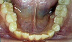 FIGURA 5 Foto Intrabucal Oclusal inferior