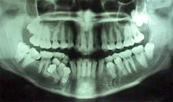 FIGURA 6 Radiografía panorámica