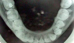 FIGURA 7 Radiografía oclusal inferior