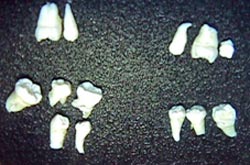 FIGURA 8 Dientes supernumerarios extraídos