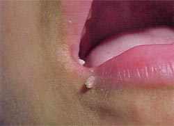 Figura 1. Verrugas vulgares bucales en el labio inferior por su cara externa y labio superior cara interna y externa en una niña de 12 años