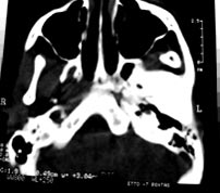 FIG. 6 T. C. corte axial (CT Sytec 2000, GE)R 