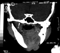 FIG. 7 T. C. corte coronal (CT Sytec 2000, GE)R