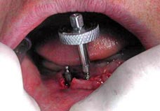 Fig. 3. Inserción de implantes IMETI con la O Ring.