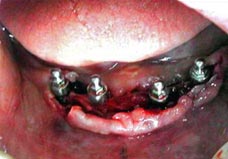 Fig. 4. Terminación de la inserción de los llave hexagonal Implantes. Véase la extensión del colgajo.