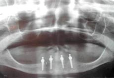 Fig. 6. Radiografia Panoramica post-operatoria