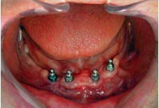 Fig. 7. Implantes en Boca. Se observa 2 meses después de colocados, buena cicatrización sin lesiones de tejidos adyacentes.