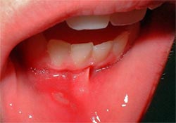 Figura 1: Estomatitis aftosa recidivante tipo minor en la cara interna derecha del labio inferior en paciente escolar que asiste a consulta