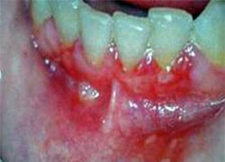 Figura 3: Estomatitis aftosa recidivante tipo herpetiforme en la cara interna del labio superior