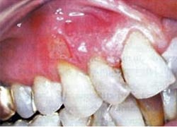 Figura 5: Estomatitis aftosa recidivante (61)