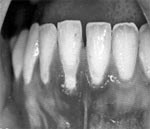 Figura 6: las formas recurrentes de gingivoestomatitis herpética primaria en adultos a menudo son confundidas con aftas. En la mucosa palatina son visibles las vesículas individuales. La “asimetría” de la gingivitis en los dientes anteriores mandibulares excluye el diagnostico de inflamación por placa. 53-55