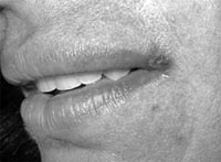 Figura 8: Lesión de herpes simple ubicada en la comisura del labio en paciente adulta femenina que asiste a consulta
