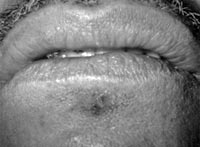 Figura 9: lesión de herpes simple ubicada debajo del labio inferior en paciente adulto masculino que asiste a consulta