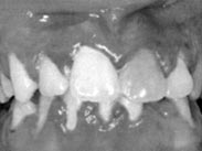 Figura 1: Gingivoestomatitis herpetica primaria: eritema difuso típico. 7