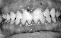 Figura 3: Gingivoestomatitis herpetica primaria: vesículas en la encia. 7