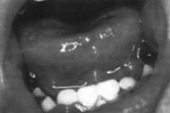 Figura 4: Gingivoestomatitis herpetica primaria: multiples lesiones vesiculoerosivas en mucosa y labios en una gingivitis permanente. 53