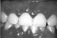 Figura 4: Gingivoestomatitis herpetica primaria: multiples lesiones vesiculoerosivas en mucosa y labios en una gingivitis permanente. 53