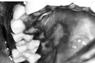 Figura 5: Gingivoestomatitis herpetica primaria: produce exema sensibilidad impidiendo el comer. 53-55