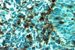 Foto Nº 8 Linfocitos T citotóxicos CD8+ en tejido de Estomatitis Aftosa Recurrente 40X