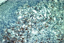 Foto Nº 9 Linfocitos T ayudadores-inductores CD4+ en tejido de Estomatitis Aftosa Recurrente 10X