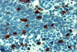 Foto Nº 10 Linfocitos T ayudadores-inductores CD4+ en tejido de Estomatitis Aftosa Recurrente 40X
