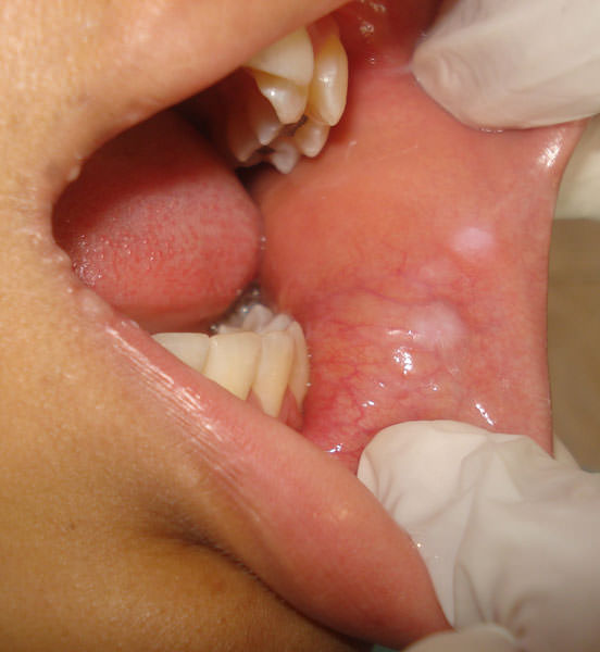 papiloma labial tratamiento)