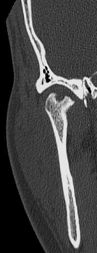 ce se întâmplă la articulațiile cu osteochondroza)