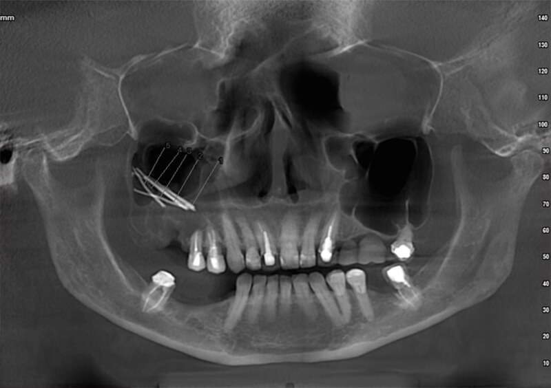 Figura 1. Radiografía panorámica: Conos de gutapercha, comunicación oroantral en el  seno maxilar derecho. Fuente propia