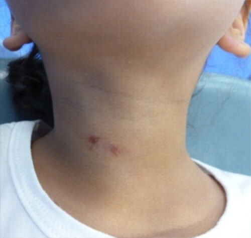 Figura 1. Lesión ulcerada en cuello. Fuente propia 