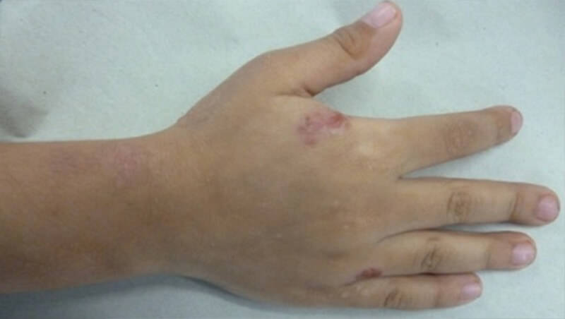 Figura 2. Lesión ulcerada en mano. Fuente propia
