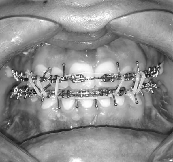 Figura 10: Fotografía intraoral