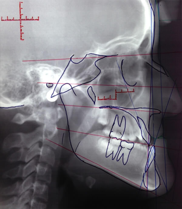 Figura 5: Trazo de cefalometria. Fuente: Propia
