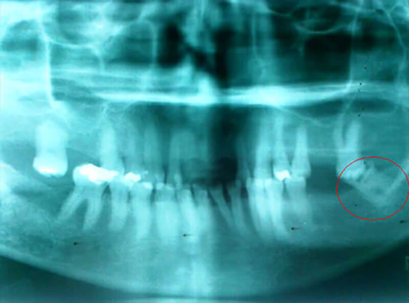 Figura N° 1: Radiografía (Rx) Panorámica ofrecida por la paciente