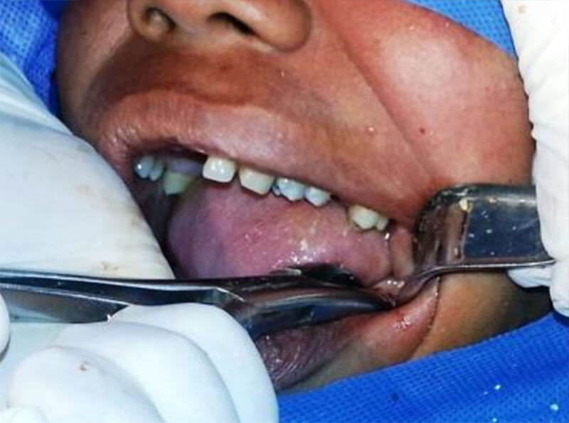Figura N° 17: Tracción de diente 3.8 con fórceps
