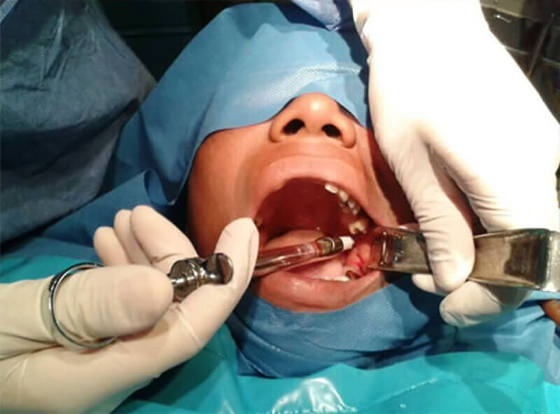 Figura N° 5: Anestesia troncular del nervio lingual, dentario inferior y bucal izquierdos