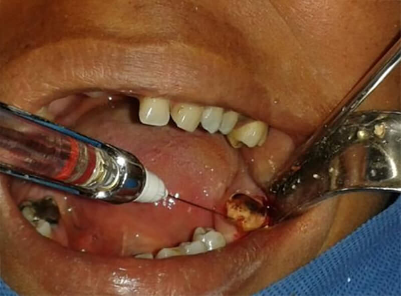 Figura N° 6: Anestesia intrapulpar del diente 3.8 