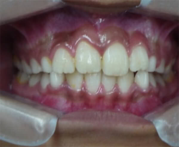 Fig. 3 Fotografías de perfil, vista frontal, lateral derecha e izquierda a1 año con 3 meses de tratamiento.