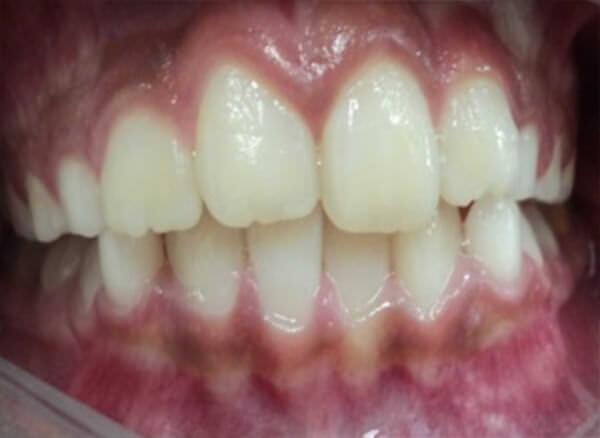 Fig. 2. Fotografías de perfil, vista frontal, lateral derecha e izquierda después de 6 meses de tratamiento.