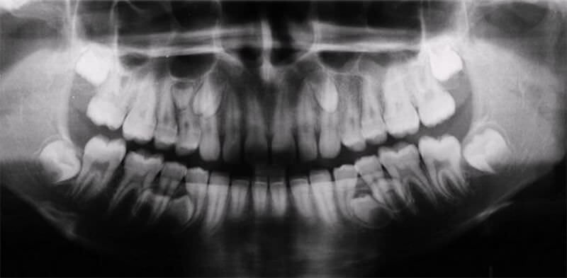 Figura 1: Radiografía Panorámica en el cual se evidencia la existencia de siete dientes supernumerarios.