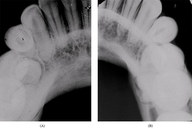 Figura 2: Radiografías oclusales de mandíbula para la localización de la posición de los dientes supernumerários en los cuadrantes (A) izquierdo y (B) derecho.