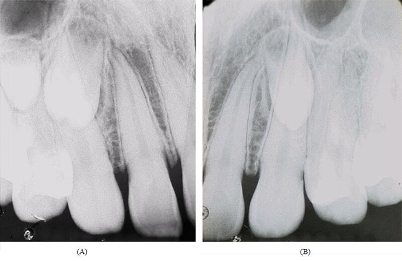 Figura 3: Radiografías periapicales del maxilar mostrando la localización de tres dientes supernumerários en los cuadrantes (A) derecho y (B) izquierdo.