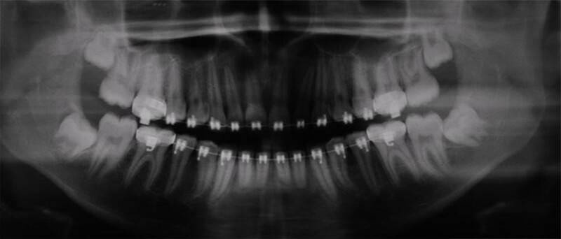 Figura 4: Radiografía Panorámica final en el cual se evidencia la ausencia de los siete dientes supernumerários