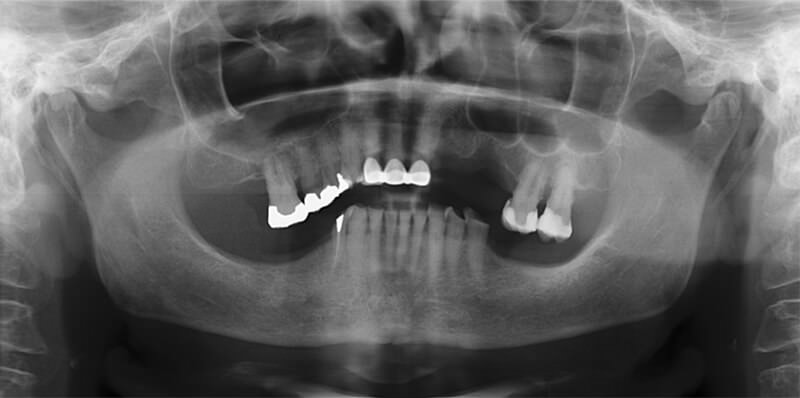 Figura 2. Imagen Radiográfica panorámica preoperatoria