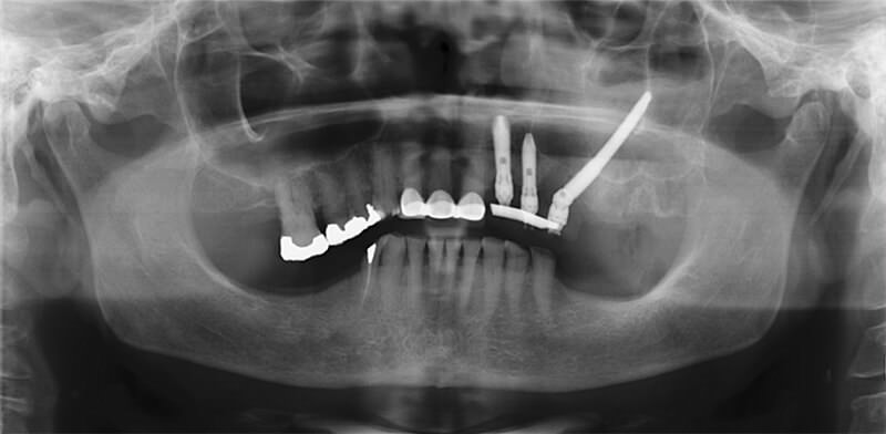 Figura 7. Radiografía panorámica postoperatoria.
