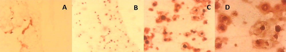 FIGURA 3.  Células mesenquimales de la pulpa dentaria humana inmersas en la matriz de colágeno tipo I, veintiún días de inducción odontogénica-osteogénica. Coloración histoquímica con Rojo Alizarina.